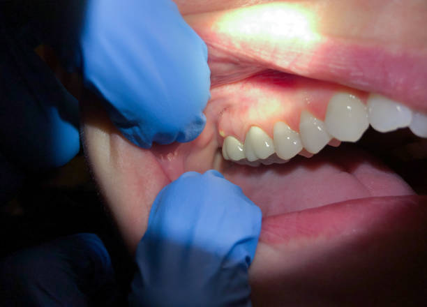 Best Emergency Tooth Extraction in Roseau, MN